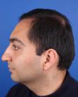After Hair Transplant&nbsp;Front